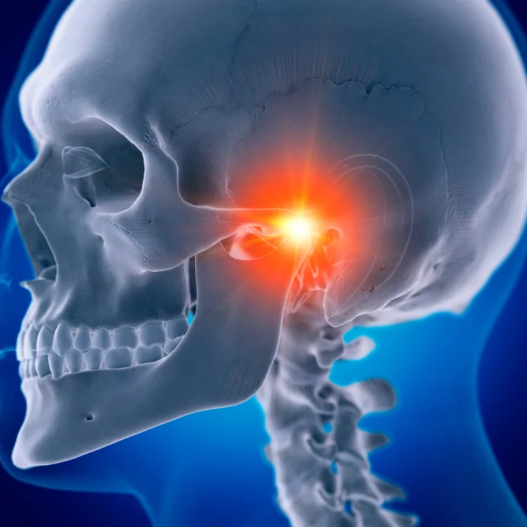 턱관절(TMJ) 통증 일러스트 — 두개골 측면에서 턱관절 부위 통증을 표시한 모습